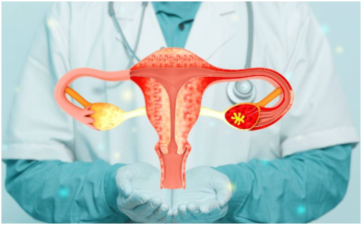 Women Worldwide Health- Endometriosis, a condition affecting millions of women